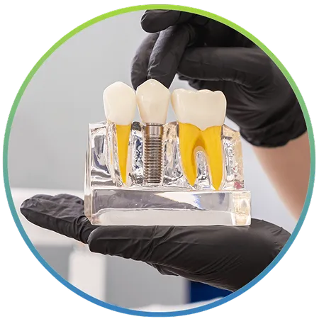 Gloved hands holding a single dental implant model