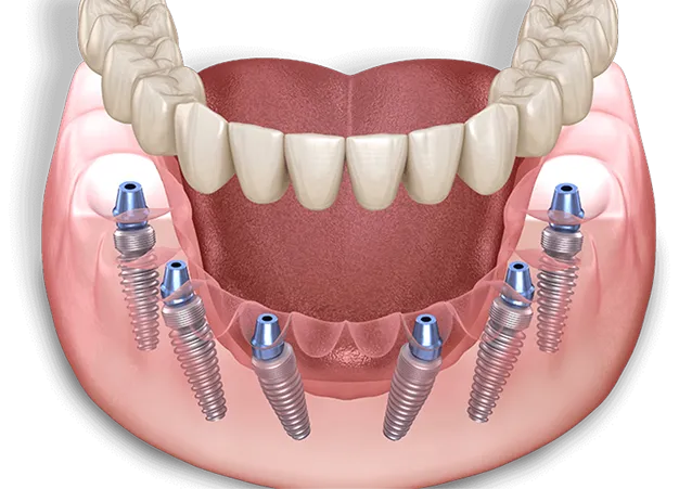Full arch dental implant model