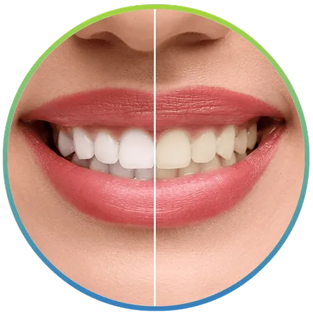 Before and after professional teeth whitening results